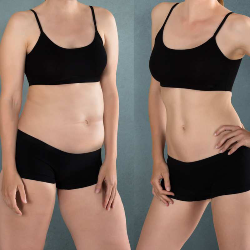 Does Fat Freezing at Home Work? DIY Devices vs Professional Cryolipolysis 2 before and after Cryolipolysis Weymouth