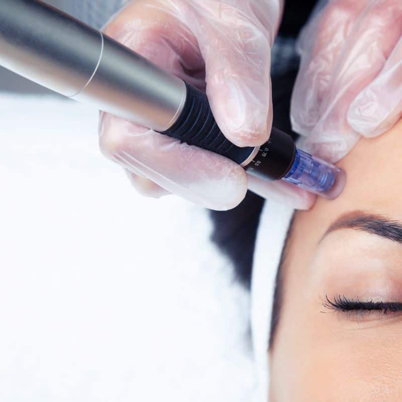 Morpheus8 treatment Weymouth from Lipo Sculpt - Book in today!